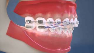 Class II Elastics  Lateral View HD Edition [upl. by Africah397]