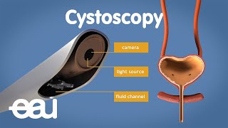 Cystoscopy overactive bladder [upl. by Binnie]