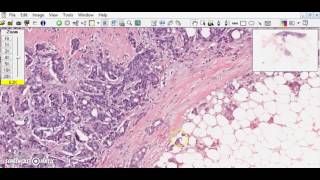 Bladder Cancer  Pathology mini tutorial [upl. by Ettari56]