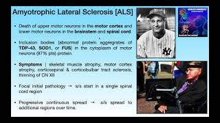 Amyotrophic Lateral Sclerosis ALS  Basics amp Clinical Presentation [upl. by Hakceber]