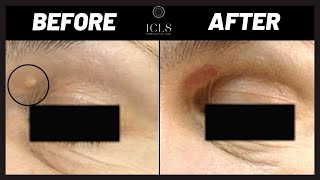 Remove Xanthelasma from Eye Lids  Before amp After Photos  ICLS Dermatology amp Plastic Surgery [upl. by Bonine]