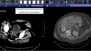 CT Urogram [upl. by Merari]