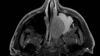 Inverted Papilloma [upl. by Meyeroff]