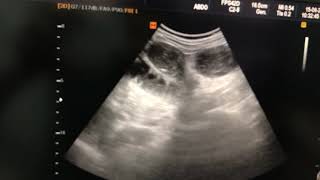 Paralytic ileus ultrasound [upl. by Dauf214]