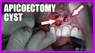 Apicoectomy Cyst SURGERY [upl. by Rebecca341]