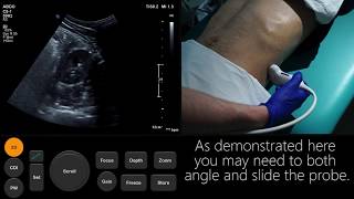 Ultrasound Tutorial Kidney amp Bladder  Urinary Tract  Radiology Nation [upl. by Ynffit]