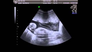 Pregnancy 8 months baby ultrasound [upl. by Ludovika468]