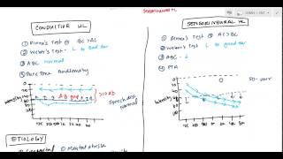 Conductive and Sensorineural Hearing Loss Deafness for USMLE [upl. by Nyllewell]