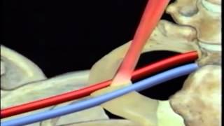 Tunneled Hickman Catheter Insertion BARD [upl. by Tally]