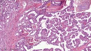 Papillary Thyroid Carcinoma  Histopathology [upl. by Minerva]