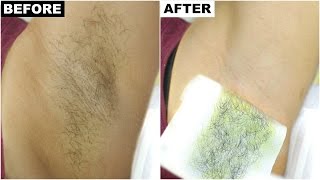 Dark Underarms amp Armpit Hair Removal  BEST amp PERMANENT Solution  Anaysa [upl. by Merrile43]