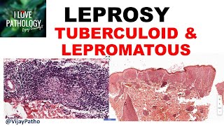 LEPROSY etiopathogenesis classification Tuberculoid amp lepromatous leprosy [upl. by Neruat496]