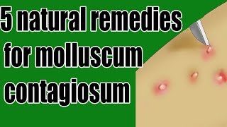 5 natural remedies for molluscum contagiosum  molluscum contagiosum Treatment [upl. by Kammerer809]