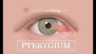 Pterygium Eye Surfers Eye Treatment Causes and Symptoms [upl. by Thekla]