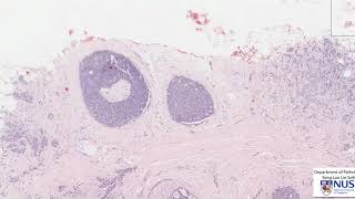 Neoplasia Nomenclature  Benign Tumors  Adenoma  Papilloma [upl. by Ninahs950]