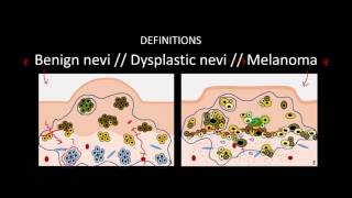 Introduction to Skin Cancer 3 Overview of Nevi and Melanoma [upl. by Meihar]