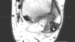 Longitudinal Split Tear Peroneus Brevis Tendon [upl. by Hirst388]