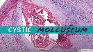 Molluscum Contagiosum cystic 5Minute Pathology Pearls [upl. by Ludlow]