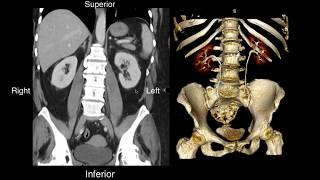 Normal Renal Anatomy [upl. by Karina]