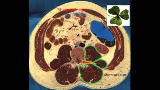 Ultrasound guided Quadratus Lumborum Block QLB1 [upl. by Aicilf]