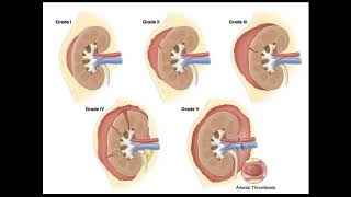 Blunt Abdominal Trauma Part 4 Renal Injury [upl. by Clova732]