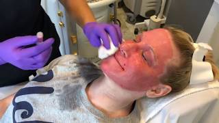 TRL Laser For A Dramatic Skin Rejuvenation [upl. by Yelich]