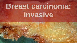 Short Review Invasive Lobular Carcinoma Breast  Histiocytoid Type [upl. by Bigford]