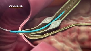 QuickPlaceV Biliary Stent [upl. by Haywood]