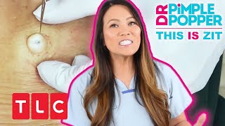 This is Zit Geschwür am Rücken  Dr Pimple Popper  TLC Deutschland [upl. by Yuk]