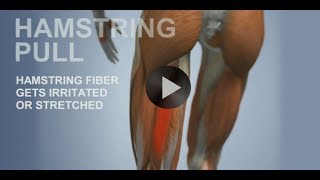 Common Sports Injuries Hamstring Pull [upl. by Joice58]