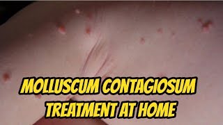 Molluscum contagiosum Treatment At Home [upl. by Presber]