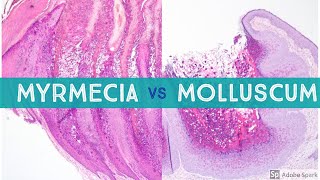 Molluscum vs Myrmecia Wart  Dermpath Lookalikes [upl. by Elokkin]