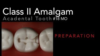 Class II Amalgam Preparation  18 MO Acadental Typodont [upl. by Burbank]