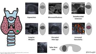 Thyroid Nodules [upl. by Crisey542]