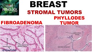 Breast Cancer Type and Stage What You Need to Know [upl. by Oby]