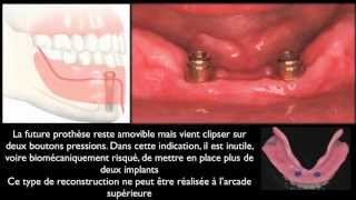 Prothèse amovible et implants dentairesMandibular overdentures [upl. by Einwahs]