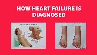 How Heart Failure is Diagnosed [upl. by Keare325]