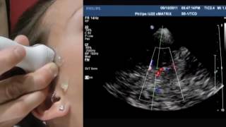 How To Transcranial Doppler [upl. by Fey711]