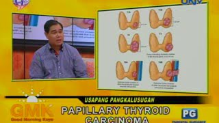 Papillary Thyroid Carcinoma [upl. by Laughlin]