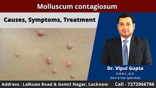 Molluscum contagiosum  Causes Symptoms Treatment [upl. by Eizzil]