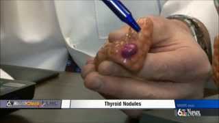 Thyroid Nodules [upl. by Bolan99]