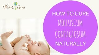 How To Cure Molluscum Contagiosum Naturally [upl. by Naened]