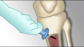 Placement of an Intraosseous Line by MKleinman  OPENPediatrics [upl. by Lorita]