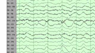 EEG basics [upl. by Wong]