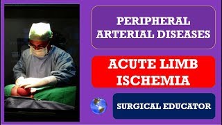 ACUTE LOWER LIMB ISCHEMIA How To DIAGNOSE amp TREAT Peripheral Arterial Diseases [upl. by Gelasius]