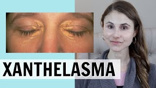 XANTHELASMA WHAT IT IS amp HOW IT IS TREATED DR DRAY [upl. by Ronnoc455]