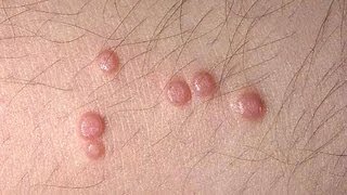 DermTV  Molluscum Contagiosum DermTVcom Epi 445 [upl. by Nellak]