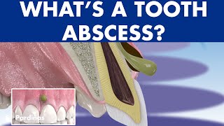 TOOTH ABSCESS dental infection  PHLEGMON symptoms and treatment © [upl. by Erdnaxela]