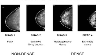 Breast Benign Tumours  Pathology mini tutorial [upl. by Nobie]