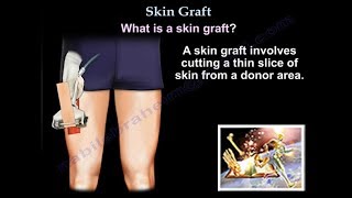 Skin Graft  Everything You Need To Know  Dr Nabil Ebraheim [upl. by Notsud]